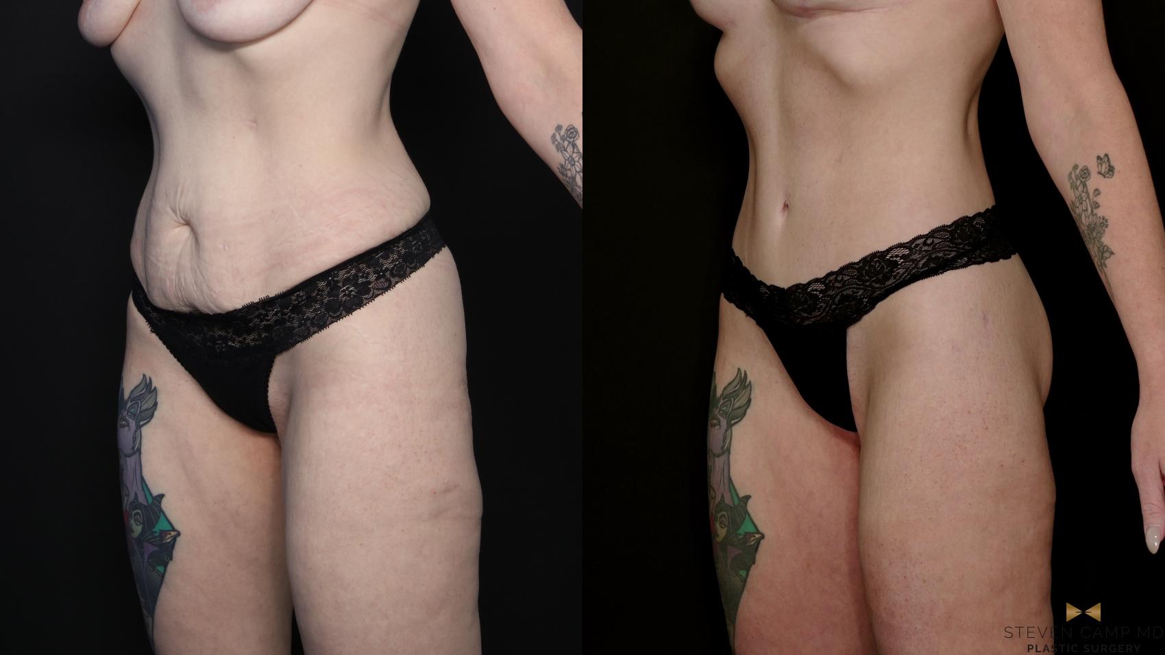 Before & After Tummy Tuck Case 738 Left Oblique View in Fort Worth & Arlington, Texas