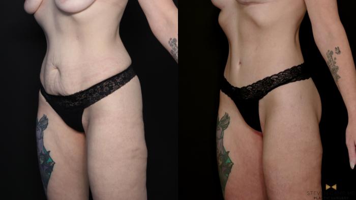 Before & After Tummy Tuck Case 738 Left Oblique View in Fort Worth & Arlington, Texas