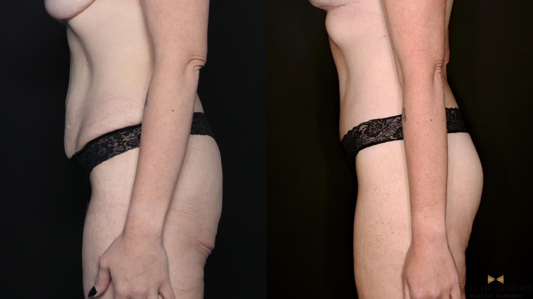 Before & After Tummy Tuck Case 738 Left Side View in Fort Worth & Arlington, Texas