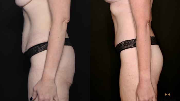 Before & After Tummy Tuck Case 738 Left Side View in Fort Worth & Arlington, Texas