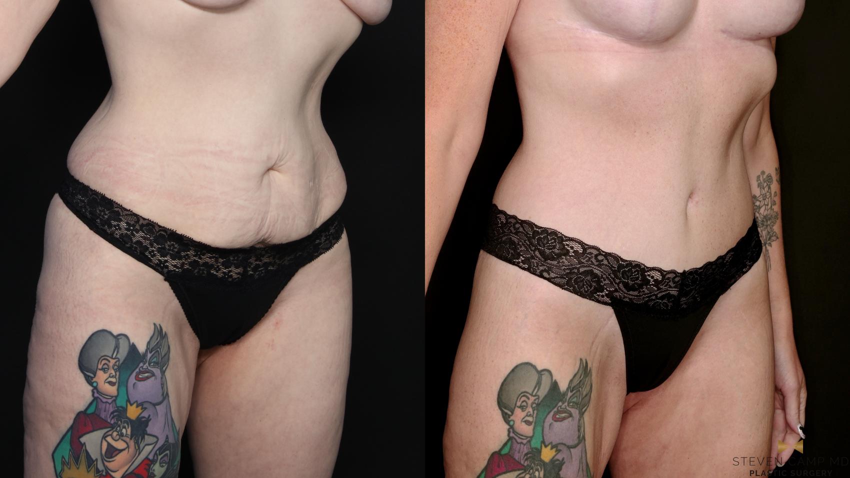 Before & After Tummy Tuck Case 738 Right Oblique View in Fort Worth & Arlington, Texas