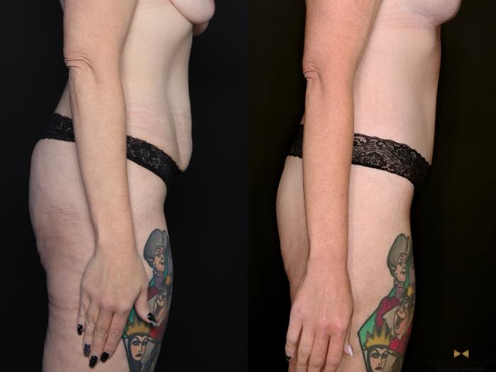 Before & After Tummy Tuck Case 738 Right Side View in Fort Worth & Arlington, Texas