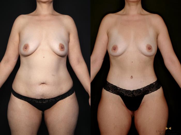 Before & After Tummy Tuck Case 747 Front View in Fort Worth & Arlington, Texas