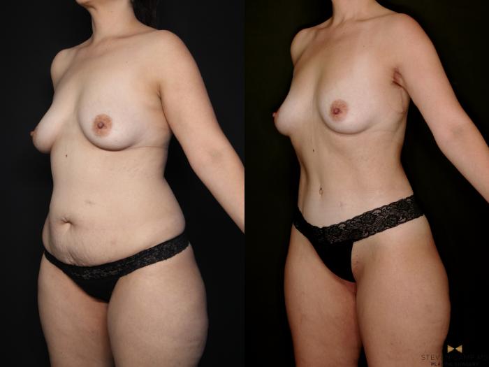 Before & After Tummy Tuck Case 747 Left Oblique View in Fort Worth & Arlington, Texas
