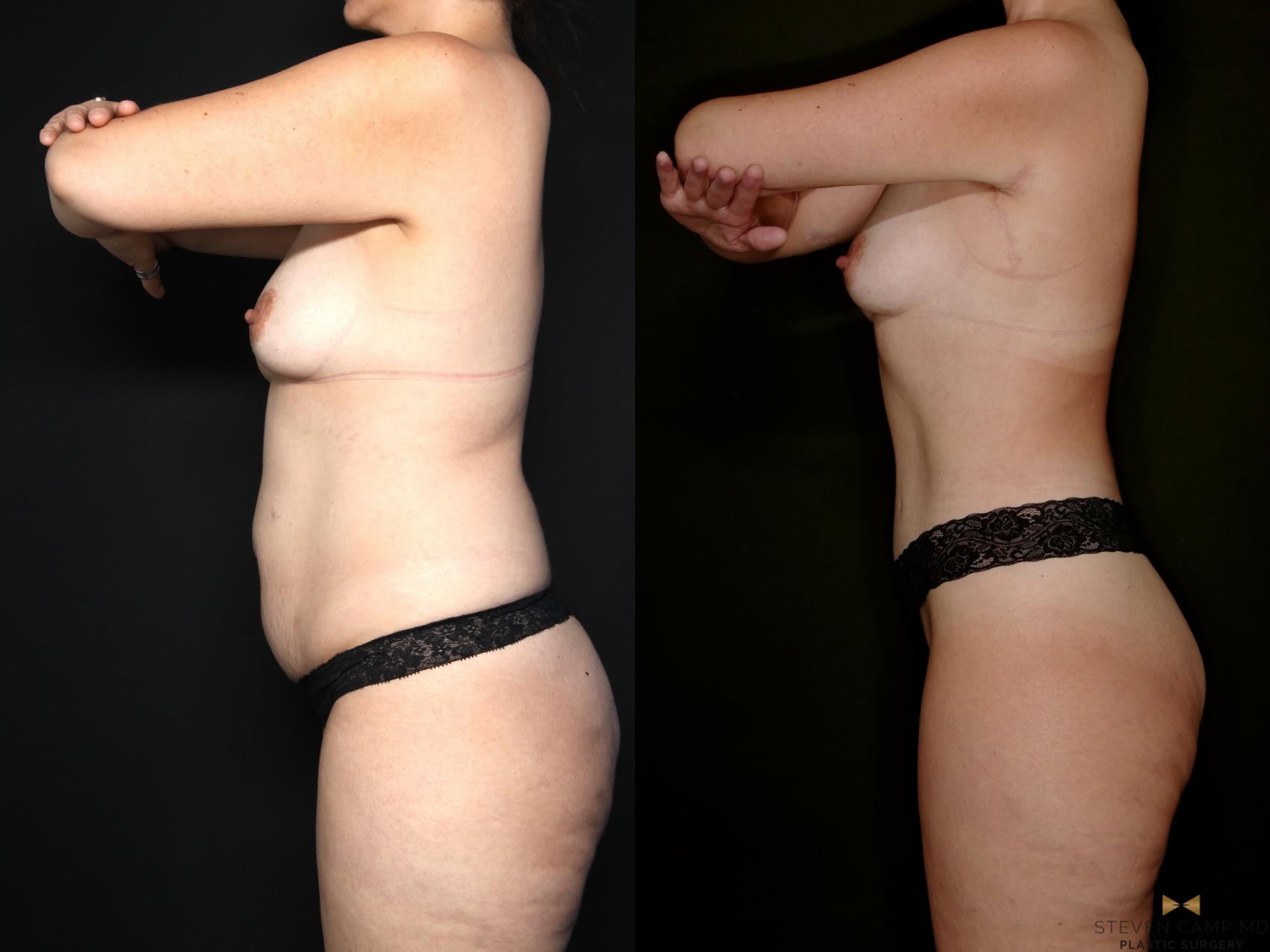 Before & After Tummy Tuck Case 747 Left Side View in Fort Worth & Arlington, Texas