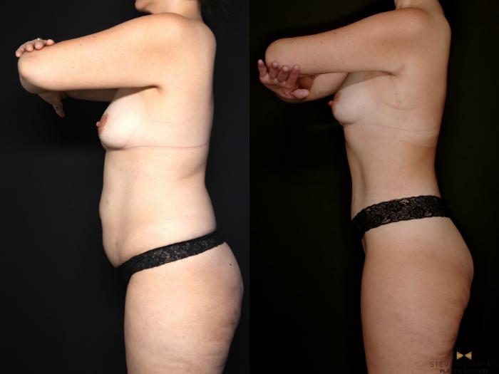 Before & After Tummy Tuck Case 747 Left Side View in Fort Worth & Arlington, Texas