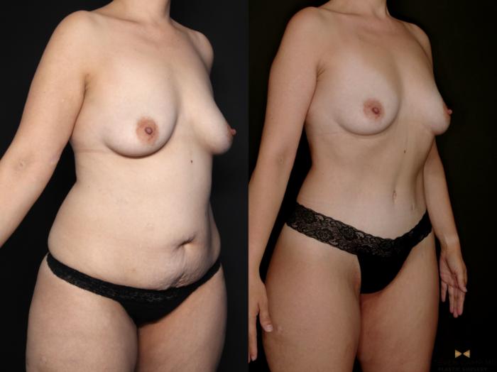Before & After Tummy Tuck Case 747 Right Oblique View in Fort Worth & Arlington, Texas