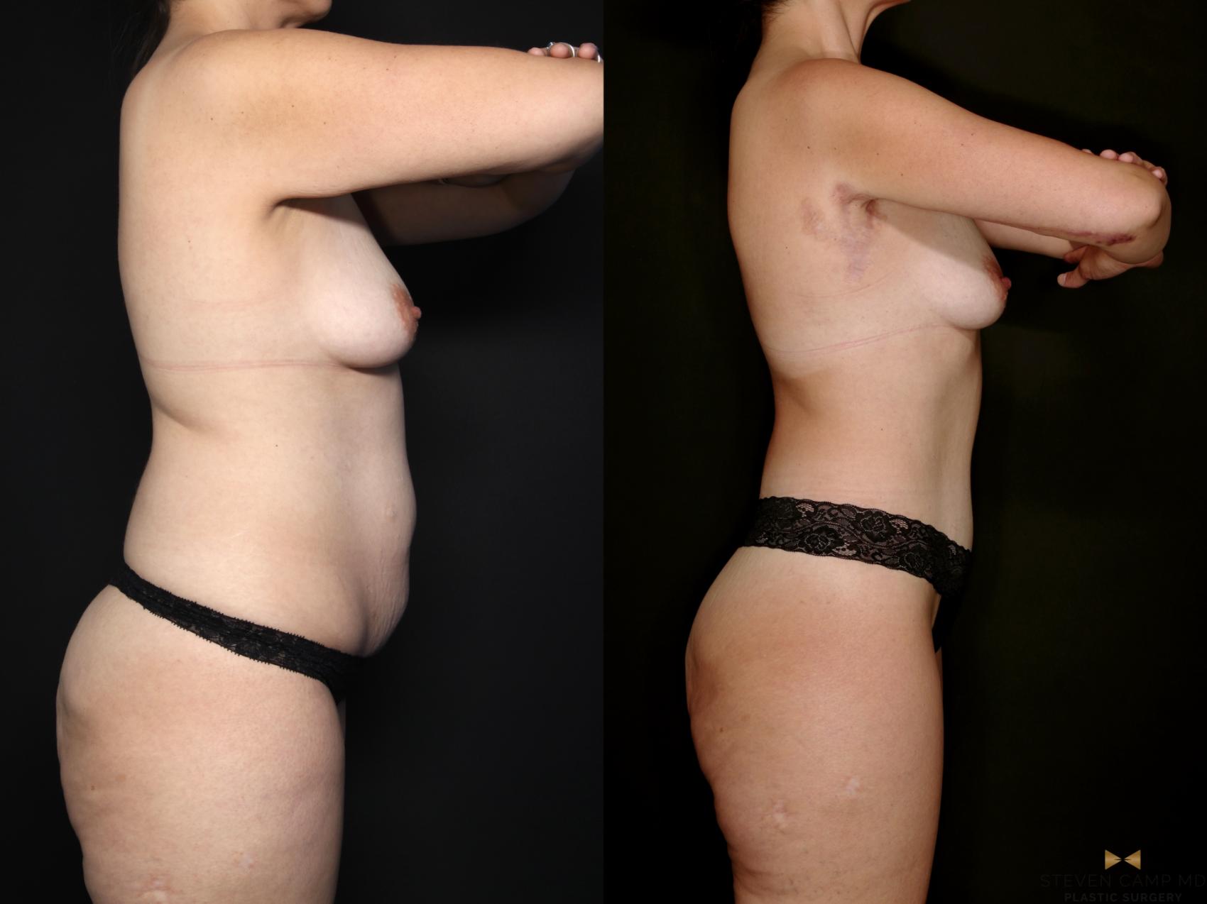 Before & After Tummy Tuck Case 747 Right Side View in Fort Worth & Arlington, Texas