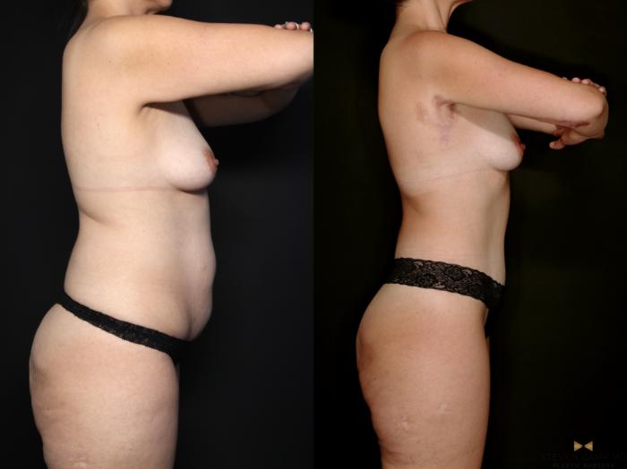 Before & After Tummy Tuck Case 747 Right Side View in Fort Worth & Arlington, Texas