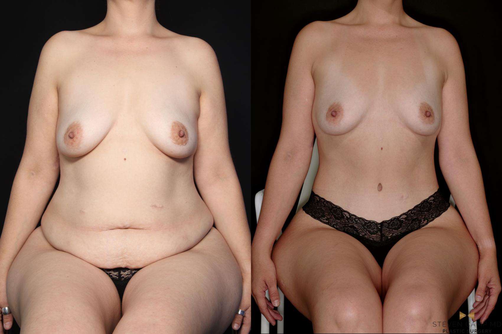 Before & After Tummy Tuck Case 747 Seated View in Fort Worth & Arlington, Texas