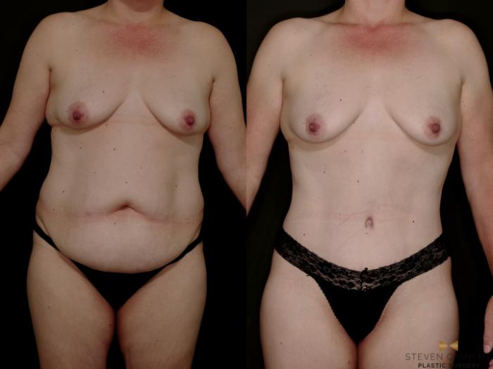 Before & After Tummy Tuck Case 770 Front View in Fort Worth & Arlington, Texas