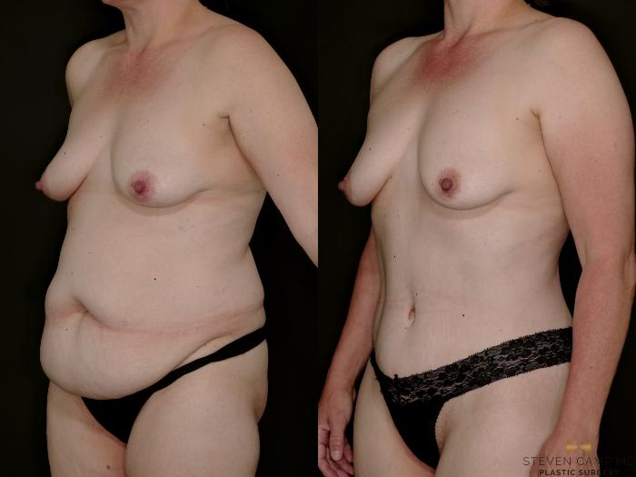 Before & After Tummy Tuck Case 770 Left Oblique View in Fort Worth & Arlington, Texas