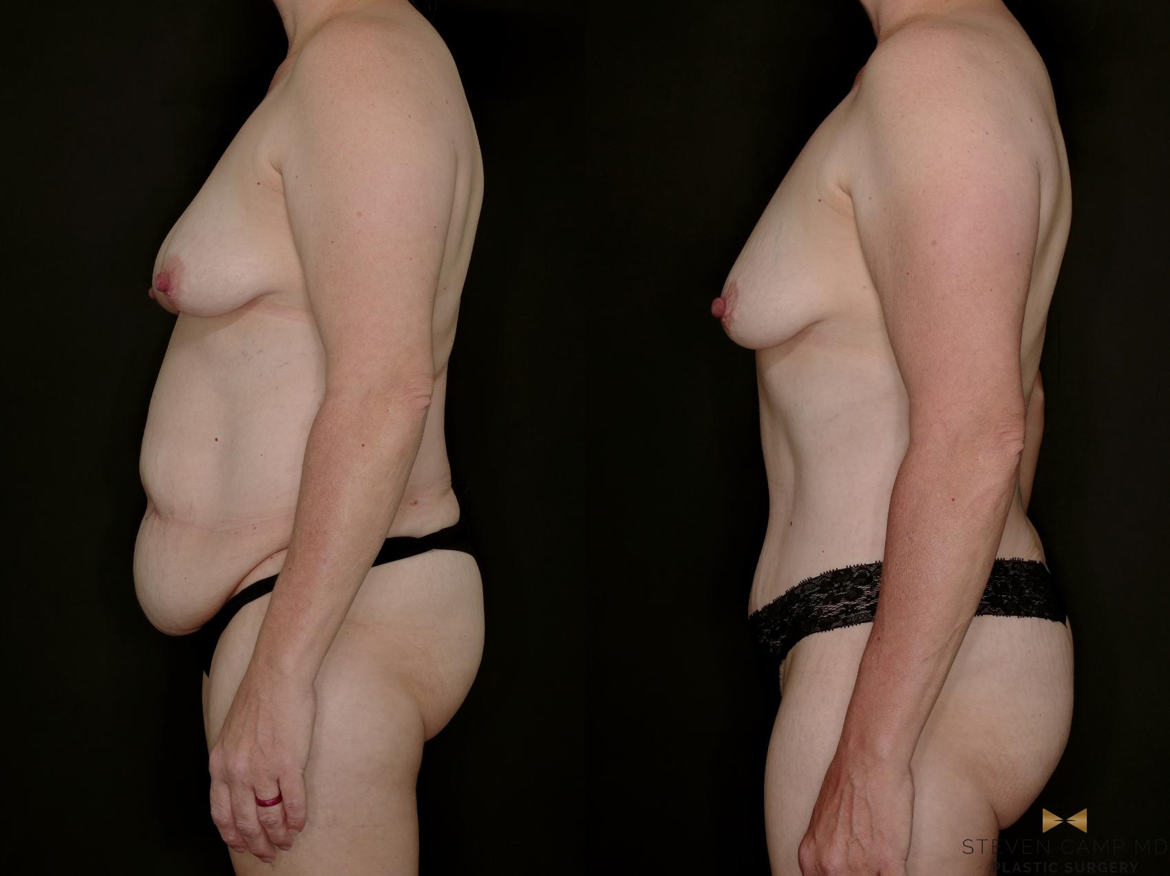Before & After Tummy Tuck Case 770 Left Side View in Fort Worth & Arlington, Texas