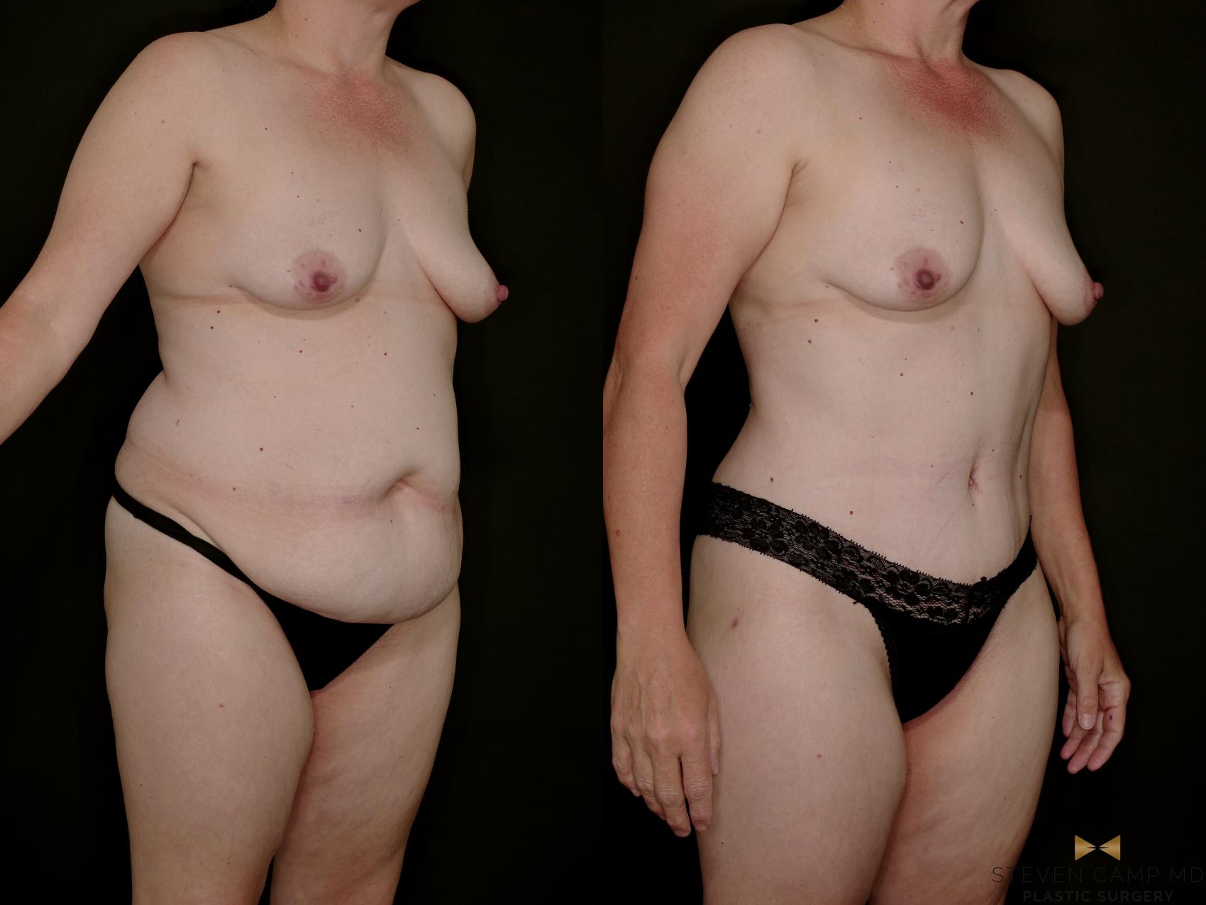 Before & After Tummy Tuck Case 770 Right Oblique View in Fort Worth & Arlington, Texas