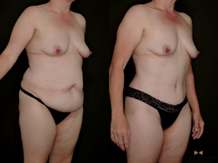 Before & After Tummy Tuck Case 770 Right Oblique View in Fort Worth & Arlington, Texas