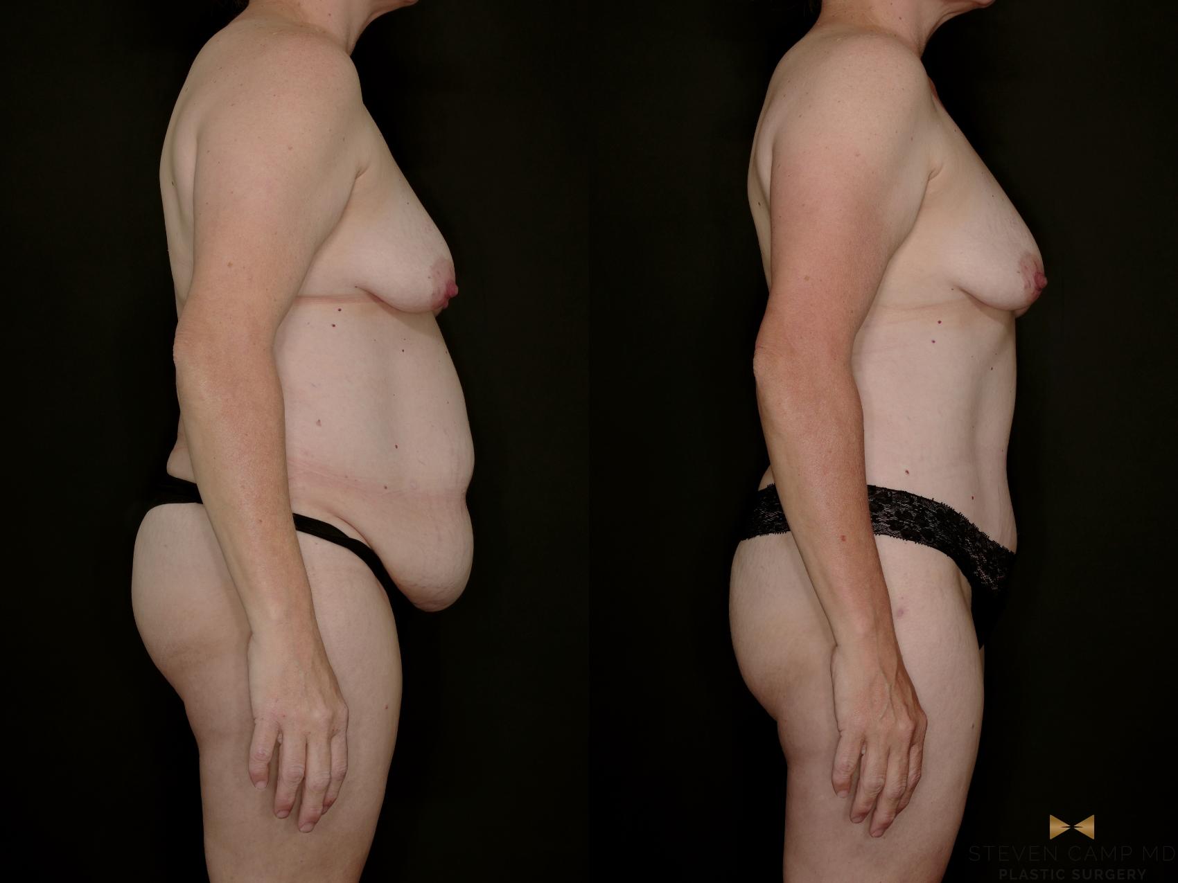 Before & After Tummy Tuck Case 770 Right Side View in Fort Worth & Arlington, Texas