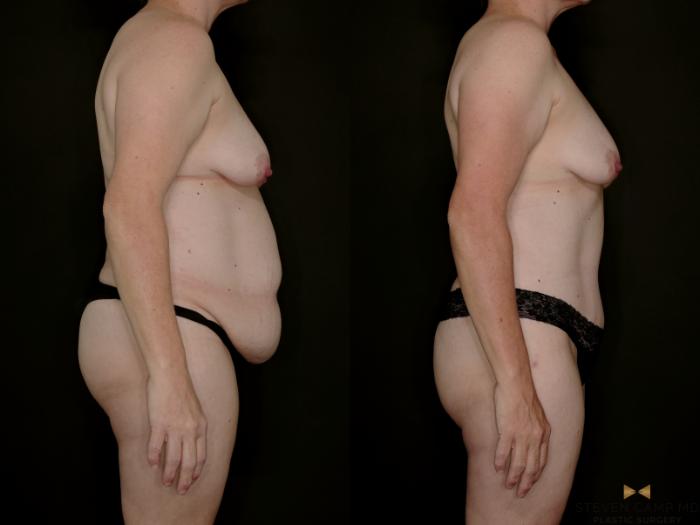 Before & After Tummy Tuck Case 770 Right Side View in Fort Worth & Arlington, Texas