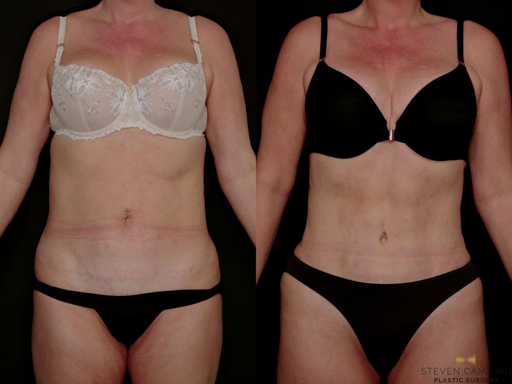 Before & After Tummy Tuck Case 771 Front View in Fort Worth & Arlington, Texas