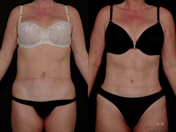 Before & After Tummy Tuck Case 771 Front View in Fort Worth & Arlington, Texas