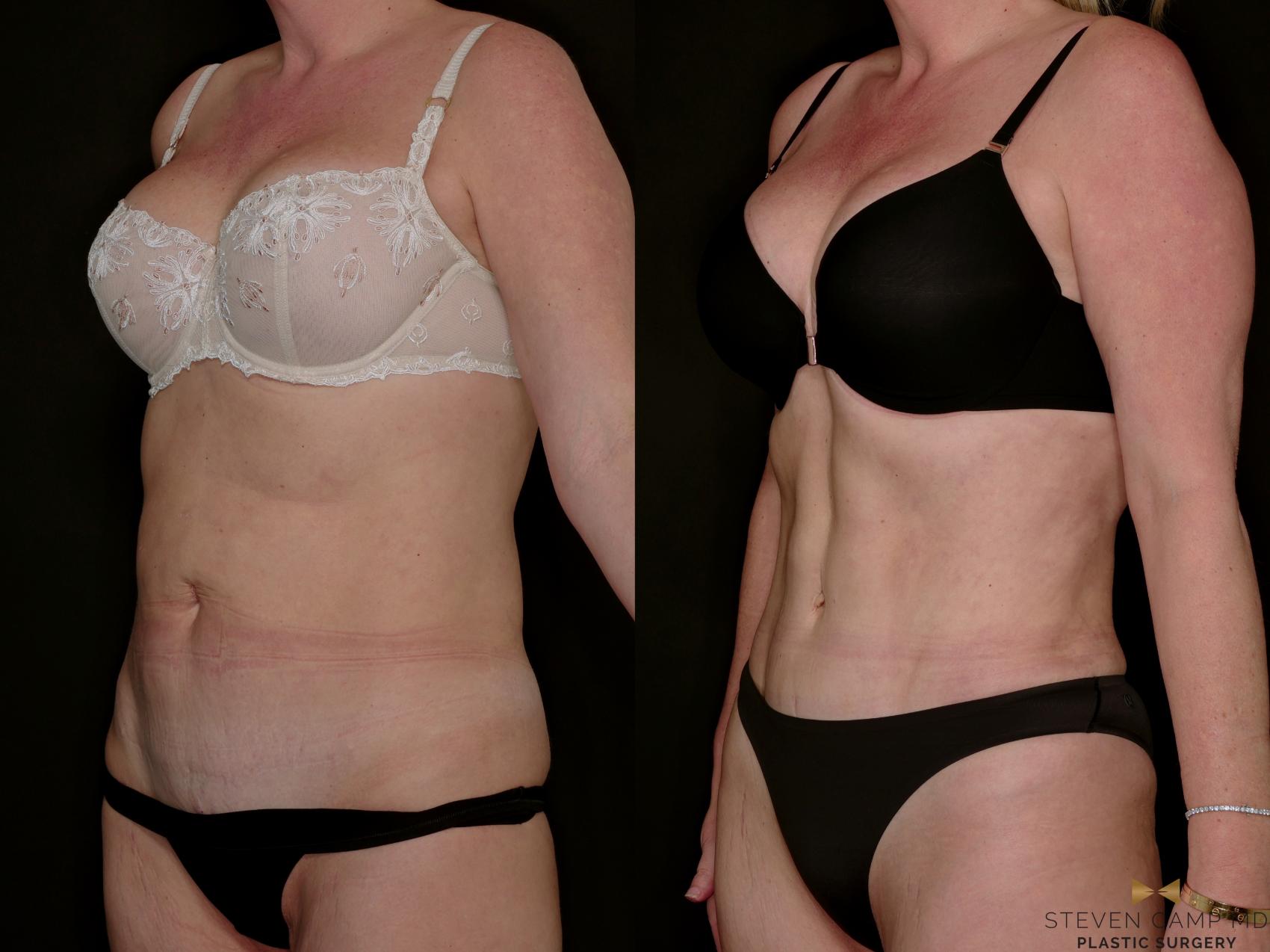 Before & After Tummy Tuck Case 771 Left Oblique View in Fort Worth & Arlington, Texas