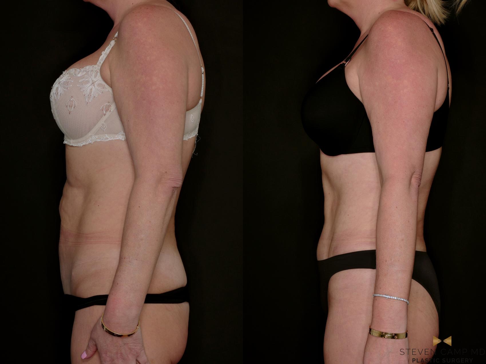 Before & After Tummy Tuck Case 771 Left Side View in Fort Worth & Arlington, Texas
