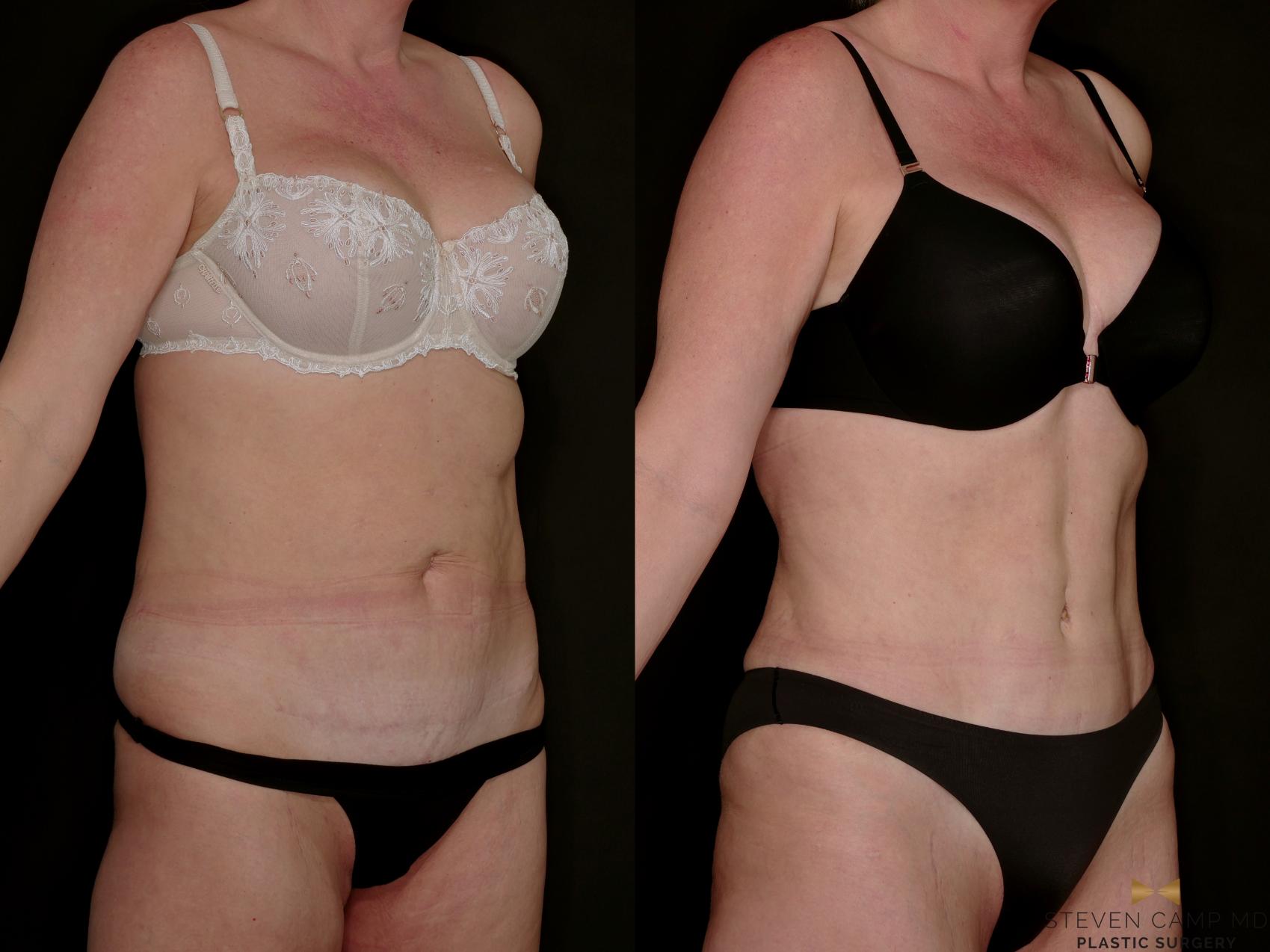 Before & After Tummy Tuck Case 771 Right Oblique View in Fort Worth & Arlington, Texas
