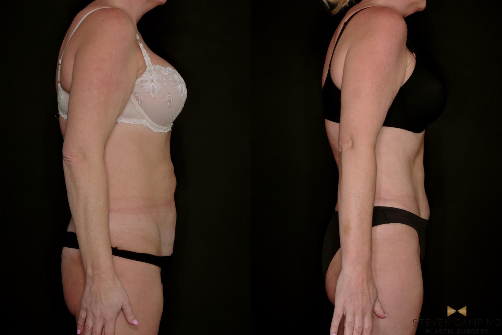 Before & After Tummy Tuck Case 771 Right Side View in Fort Worth & Arlington, Texas