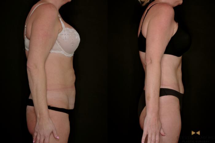 Before & After Tummy Tuck Case 771 Right Side View in Fort Worth & Arlington, Texas