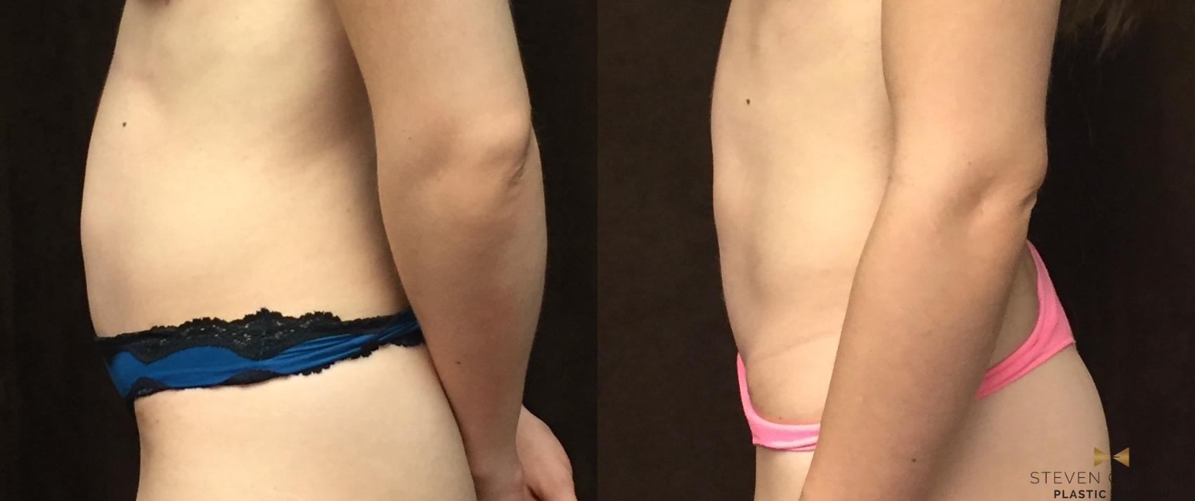 Before & After Tummy Tuck Case 88 View #1 View in Fort Worth, Texas