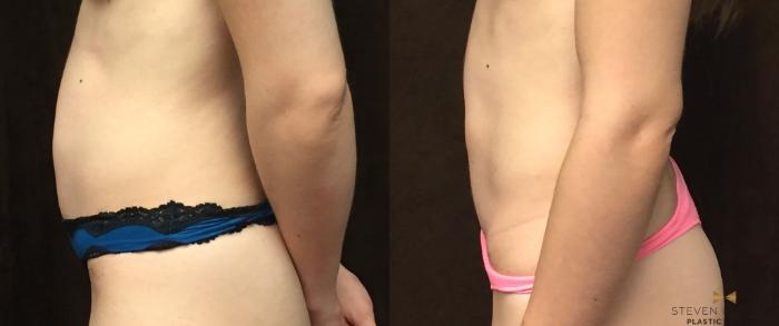 Before & After Tummy Tuck Case 88 View #1 View in Fort Worth & Arlington, Texas