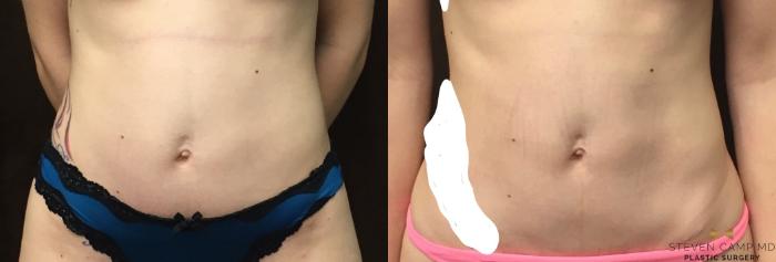 Before & After Tummy Tuck Case 88 View #2 View in Fort Worth & Arlington, Texas