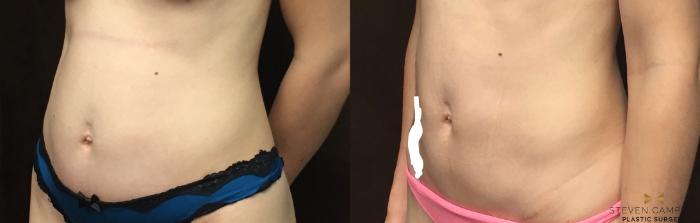 Before & After Tummy Tuck Case 88 View #3 View in Fort Worth & Arlington, Texas